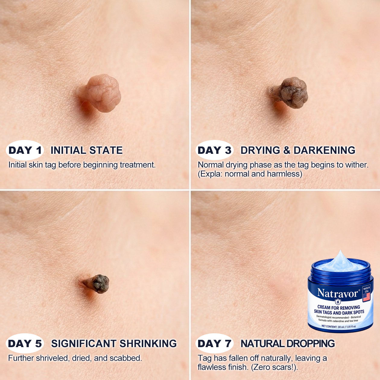 Natravor® 7-𝐃𝐚𝐲 𝐒𝐤𝐢𝐧 𝐓𝐚𝐠 & 𝐒𝐩𝐨𝐭 𝐄𝐫𝐚𝐬𝐞𝐫 𝐂𝐫𝐞𝐚𝐦 (Zero Pain, Zero 𝐒𝐜𝐚𝐫𝐬 Formula) 💎