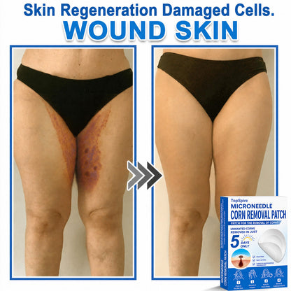✨TopSpire® 2-in-1 Microneedle & Hydrocolloid Patch | Targeted Solution for Raised Moles, Acne, Flat Warts & Skin Tags | Helps Improve the Appearance of Fine Lines, Scars & Skin Imperfections | Invisible Star Pimple Patches for Face & Body