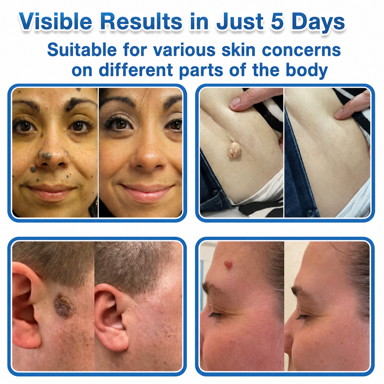 ✨TopSpire® 2-in-1 Microneedle & Hydrocolloid Patch | Targeted Solution for Raised Moles, Acne, Flat Warts & Skin Tags | Helps Improve the Appearance of Fine Lines, Scars & Skin Imperfections | Invisible Star Pimple Patches for Face & Body