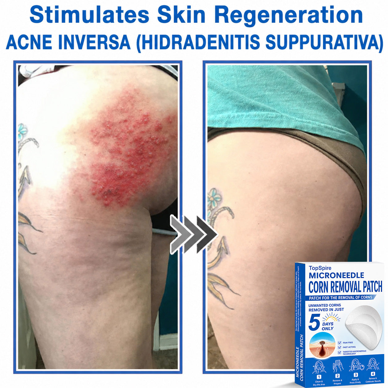✨TopSpire® 2-in-1 Microneedle & Hydrocolloid Patch | Targeted Solution for Raised Moles, Acne, Flat Warts & Skin Tags | Helps Improve the Appearance of Fine Lines, Scars & Skin Imperfections | Invisible Star Pimple Patches for Face & Body